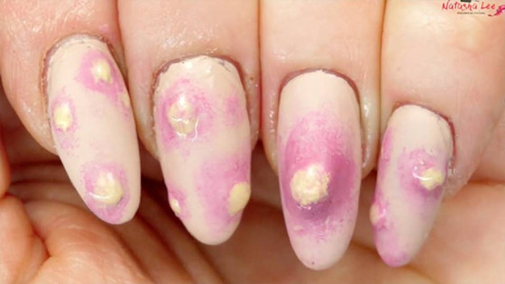 Unhas com espinhas Unhas com espinhas